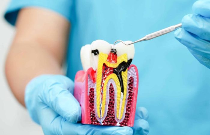 Root Canal Therapy Durango